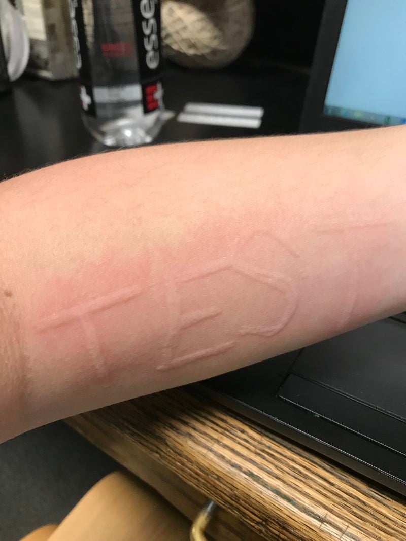 a wheal shaped like the word test on my forearm