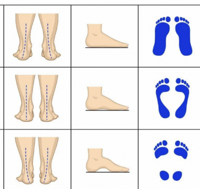 diagram showing how flat or very curved feet put pressure on the ankle